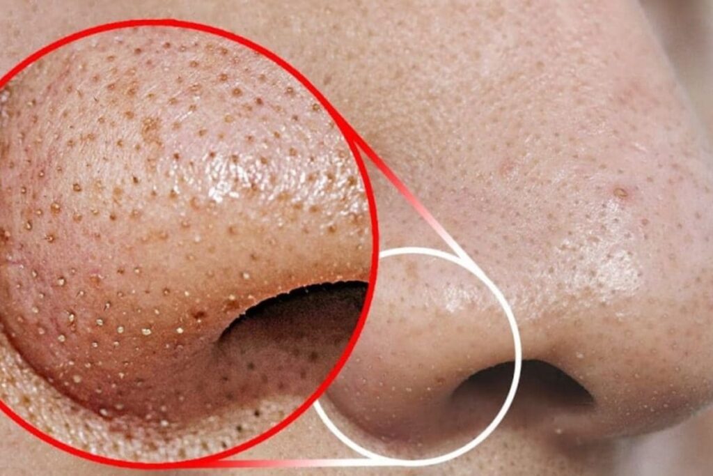 blackheads-skincare-1-2026-02-a4677f30eca996d0288adae6a45dc350-1200x800-1
