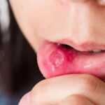 mouth-ulcers-2026-06-43608142caa1c3eceaacb814fd0b82ad-1200x800-1
