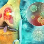 Bone-Cancer-9-2026-07-85617e93d268a4099e43ab5c46eeb51e-1200x800-1