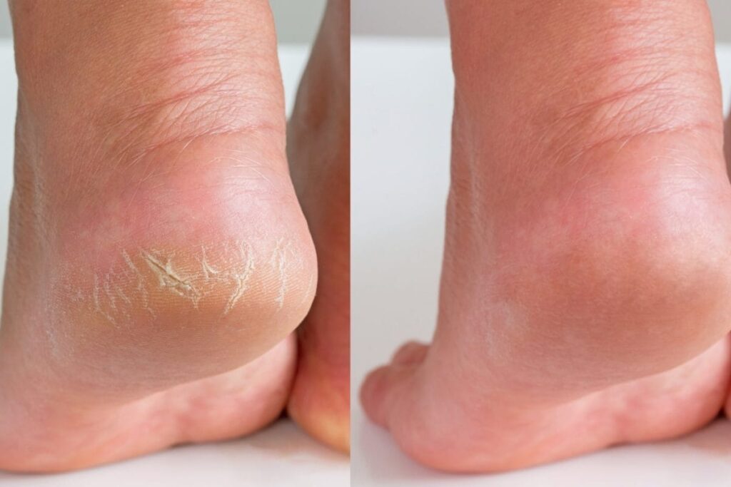 Cracked-Heels-4-2026-08-6ad6388b5d2bb05a2298458126fb753c-1200x800-1