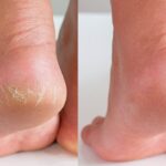 Cracked-Heels-4-2026-08-6ad6388b5d2bb05a2298458126fb753c-1200x800-1