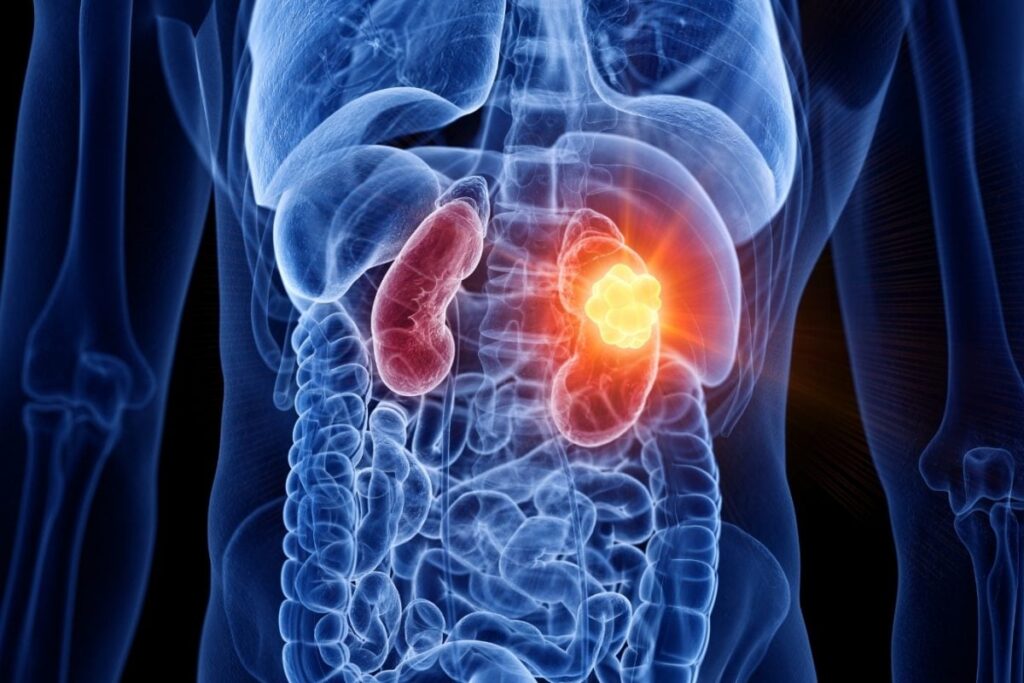 Kidney-Cancer-2026-08-5034e719b8bc751041846a4ed649c4da-1200x800-1