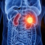 Kidney-Cancer-2026-08-5034e719b8bc751041846a4ed649c4da-1200x800-1