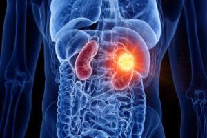 Kidney-Cancer-2026-08-5034e719b8bc751041846a4ed649c4da-1200x800-1