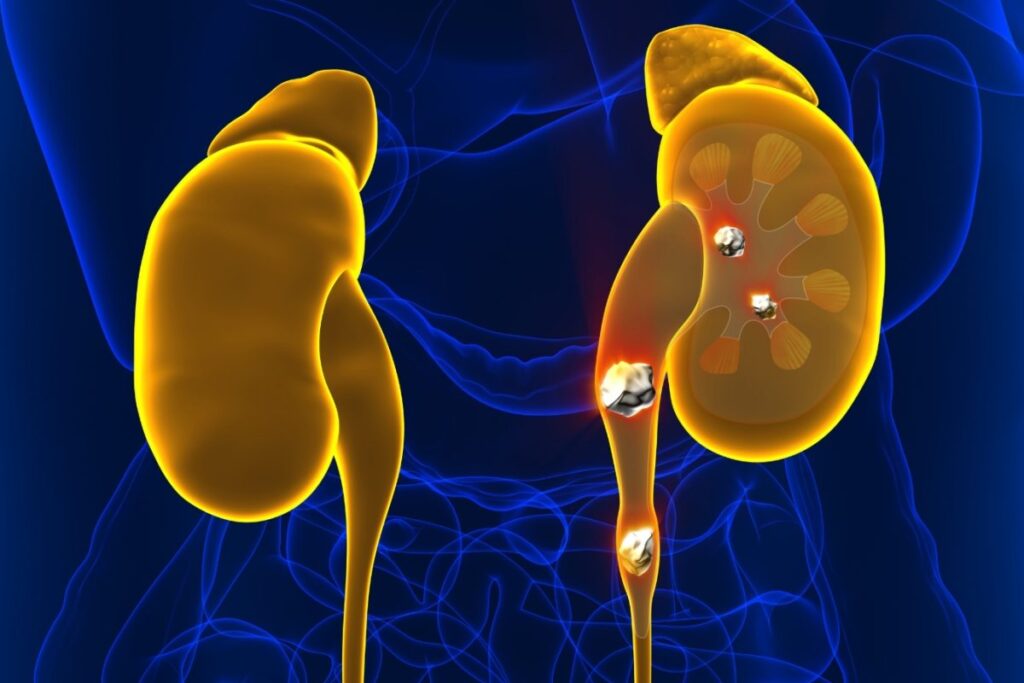 kidney-stone-1-2026-08-fa5a8d7e1e6a0cc4fbca1f016451f6ff-1200x800-1