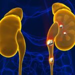 kidney-stone-1-2026-08-fa5a8d7e1e6a0cc4fbca1f016451f6ff-1200x800-1