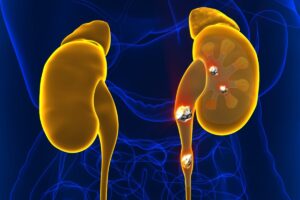 kidney-stone-1-2026-08-fa5a8d7e1e6a0cc4fbca1f016451f6ff-1200x800-1