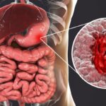 Stomach-Cancer-2-2026-09-f4bcabc40743380a4c77a482265d4bfb-1200x800-1