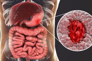 Stomach-Cancer-2-2026-09-f4bcabc40743380a4c77a482265d4bfb-1200x800-1