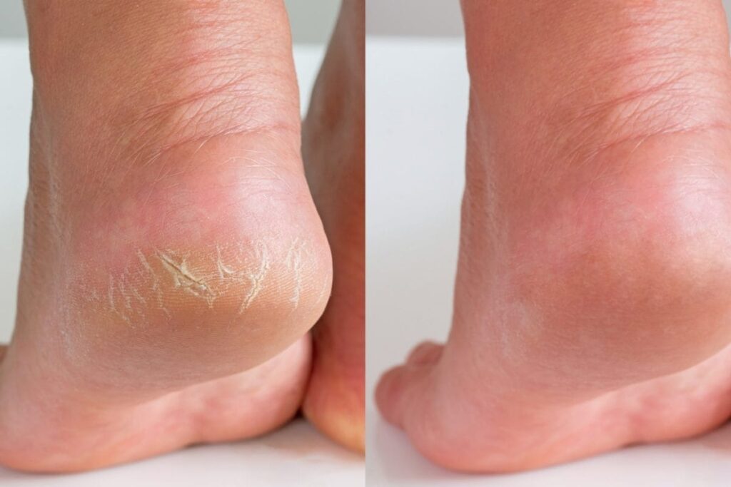 cracked-heels-5-2026-10-bd688e5e6140e0acbc6a63c489cebc69-1200x800-1