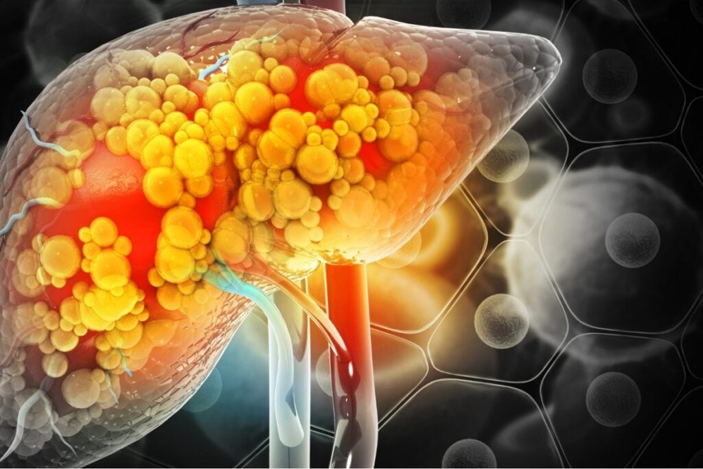fatty-liver-2026-10-c2a8c646562d5c67be58a0ebf3b1affa-1200x800-1