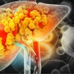 fatty-liver-2026-10-c2a8c646562d5c67be58a0ebf3b1affa-1200x800-1