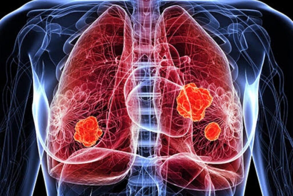 lung-cancer-2026-10-f8b373e74916b7b63738a14a2e60d45f-1200x800-1