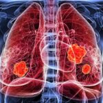 lung-cancer-2026-10-f8b373e74916b7b63738a14a2e60d45f-1200x800-1